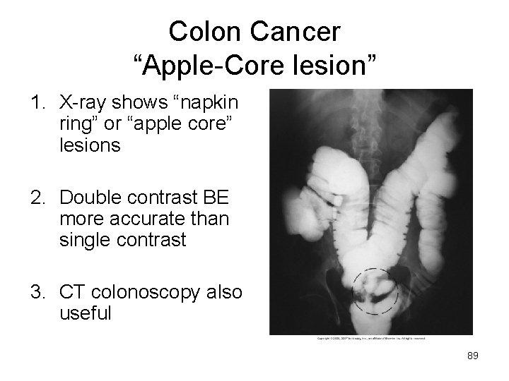 Colon Cancer “Apple-Core lesion” 1. X-ray shows “napkin ring” or “apple core” lesions 2.
