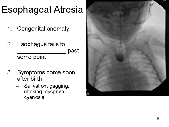 Esophageal Atresia 1. Congenital anomaly 2. Esophagus fails to ________ past some point 3.