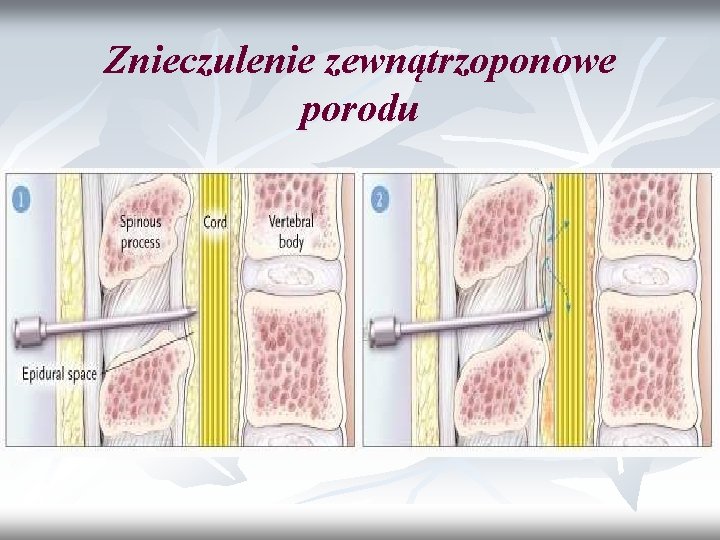 Znieczulenie zewnątrzoponowe porodu 