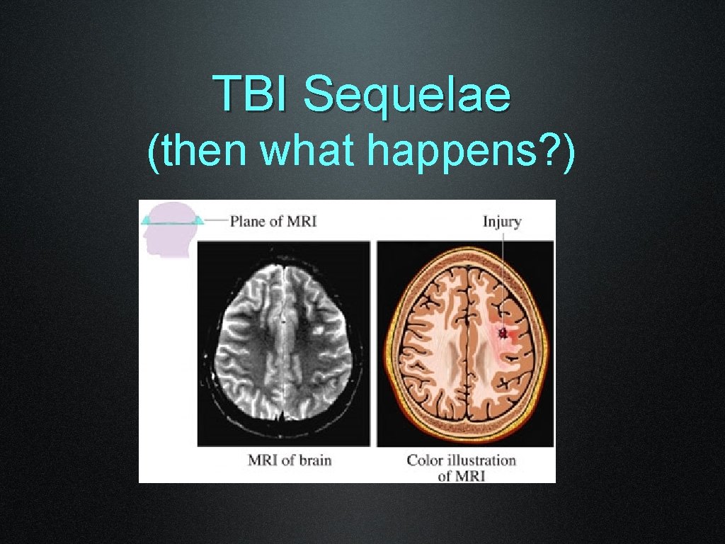 TBI Sequelae (then what happens? ) 