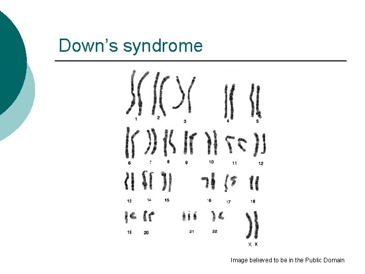 Down’s syndrome Image believed to be in the Public Domain 