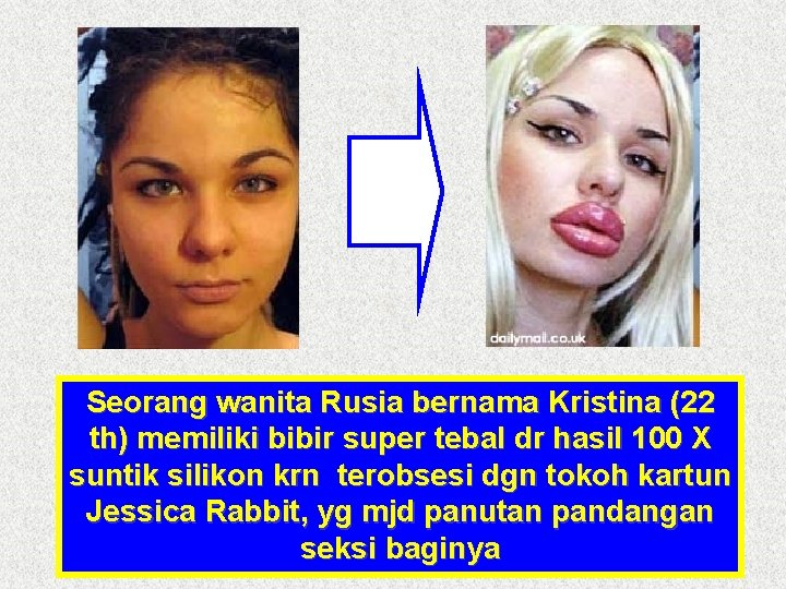 Seorang wanita Rusia bernama Kristina (22 th) memiliki bibir super tebal dr hasil 100