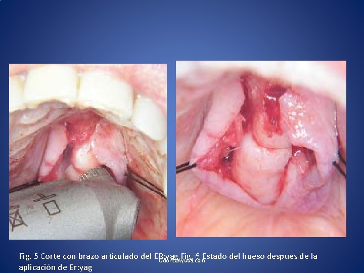 Fig. 5 Corte con brazo articulado del ER: yag Fig. 6 Estado del hueso Fig. 5 Corte con brazo articulado del ER: yag Fig. 6 Estado del hueso