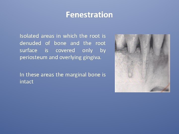 Fenestration Isolated areas in which the root is denuded of bone and the root