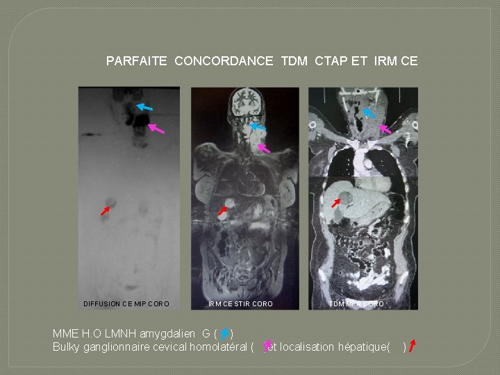 PARFAITE CONCORDANCE TDM CTAP ET IRM CE DIFFUSION CE MIP CORO IRM CE STIR