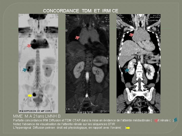 CONCORDANCE TDM ET IRM CE IRM DIFFUSION CE MIP CORO IRM CE STIR TDM