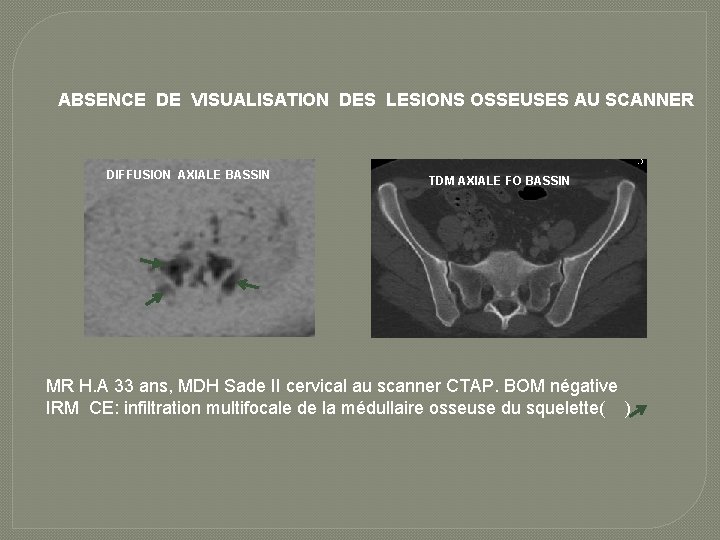 ABSENCE DE VISUALISATION DES LESIONS OSSEUSES AU SCANNER DIFFUSION AXIALE BASSIN TDM AXIALE FO