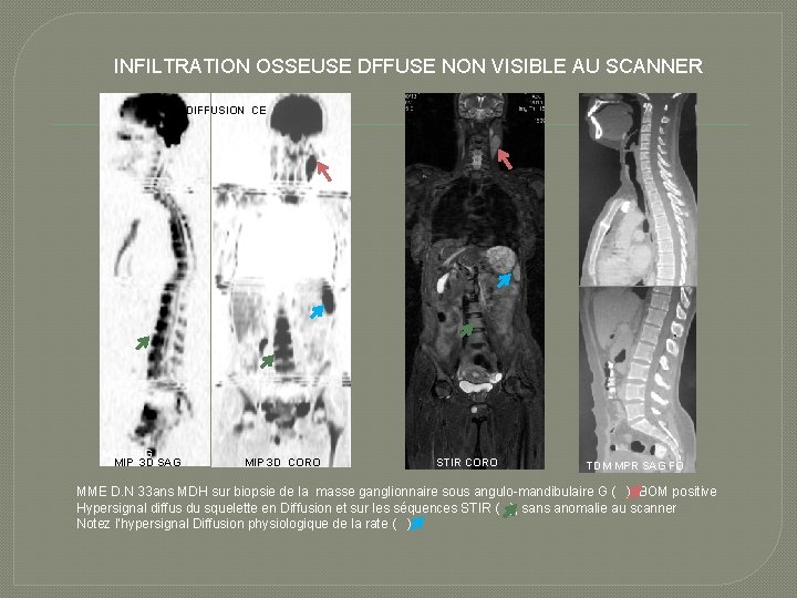 INFILTRATION OSSEUSE DFFUSE NON VISIBLE AU SCANNER DIFFUSION CE MPR SAG MIP 3 D