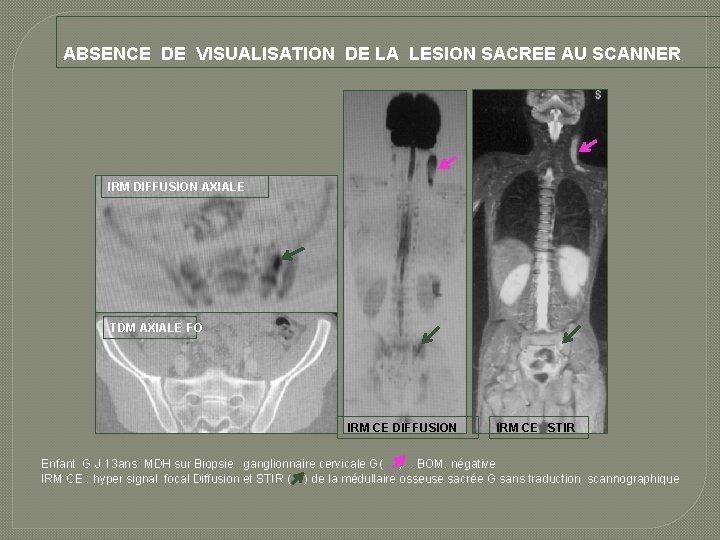 ABSENCE DE VISUALISATION DE LA LESION SACREE AU SCANNER IRM DIFFUSION AXIALE TDM AXIALE