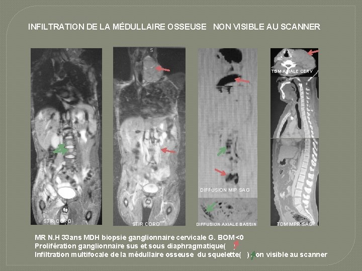 INFILTRATION DE LA MÉDULLAIRE OSSEUSE NON VISIBLE AU SCANNER TDM AXIALE CERV DIFFUSION MIP