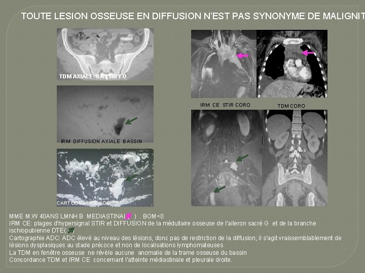 TOUTE LESION OSSEUSE EN DIFFUSION N’EST PAS SYNONYME DE MALIGNIT TDM AXIALE BASSIN FO