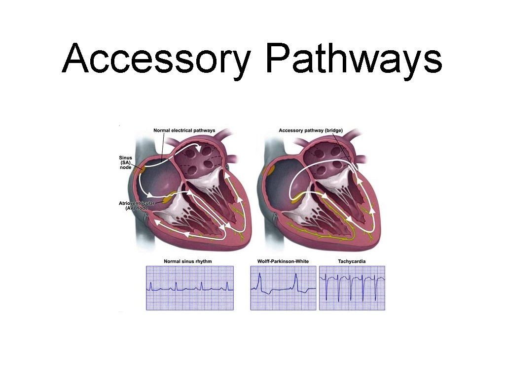 Accessory Pathways 