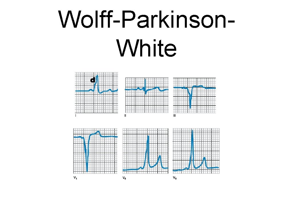 Wolff-Parkinson. White 
