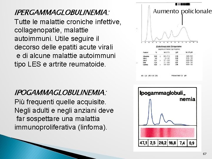 IPERGAMMAGLOBULINEMIA: Aumento policlonale Tutte le malattie croniche infettive, collagenopatie, malattie autoimmuni. Utile seguire il IPERGAMMAGLOBULINEMIA: Aumento policlonale Tutte le malattie croniche infettive, collagenopatie, malattie autoimmuni. Utile seguire il