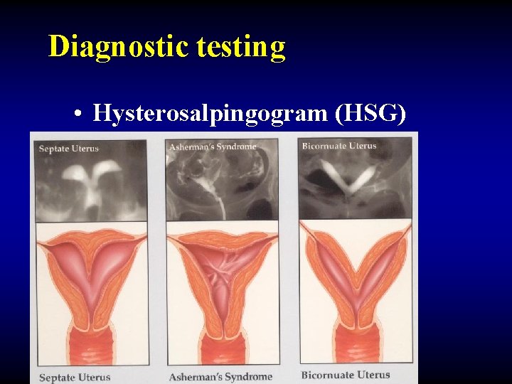 Diagnostic testing • Hysterosalpingogram (HSG) 