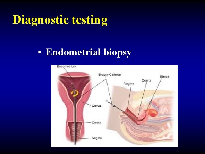Diagnostic testing • Endometrial biopsy 