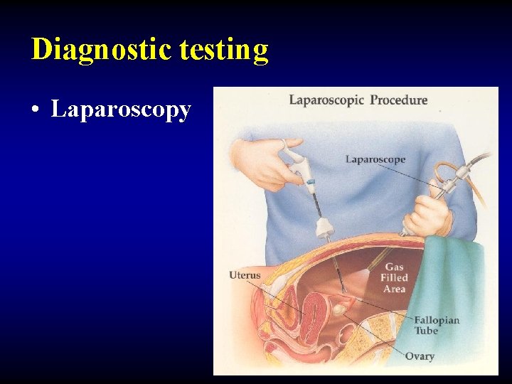 Diagnostic testing • Laparoscopy 
