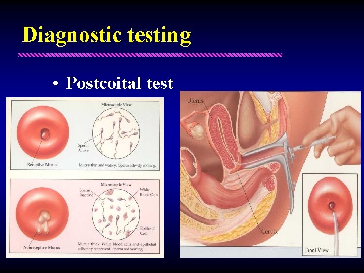 Diagnostic testing • Postcoital test 