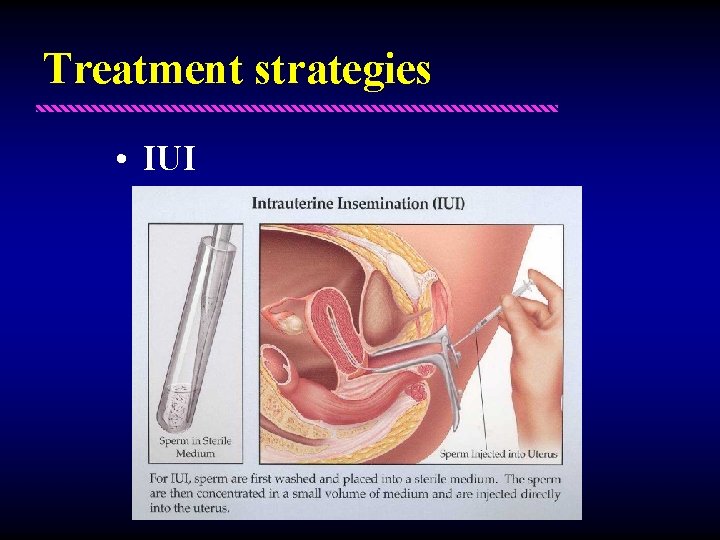 Treatment strategies • IUI – Unexplained infertility – Sexual dysfunction 