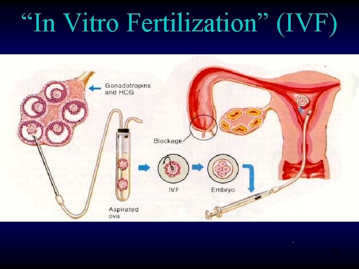 “In Vitro Fertilization” (IVF) - 30 