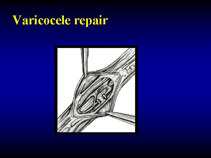 Varicocele repair 