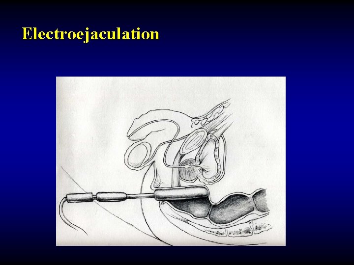 Electroejaculation 