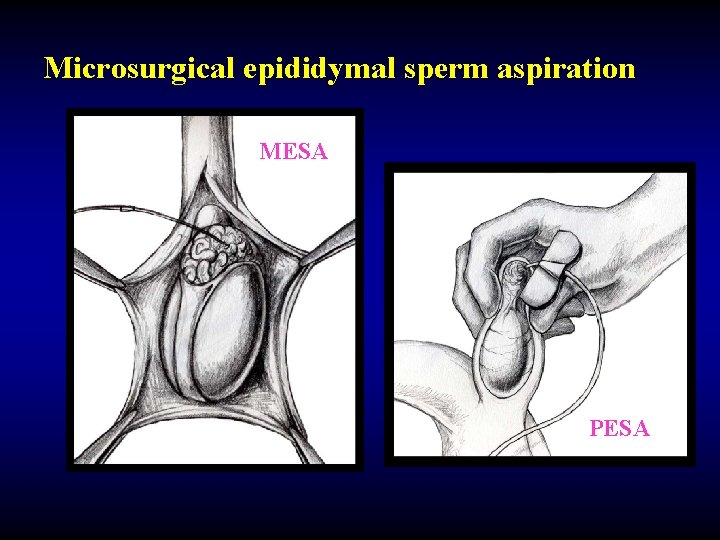Microsurgical epididymal sperm aspiration MESA PESA 