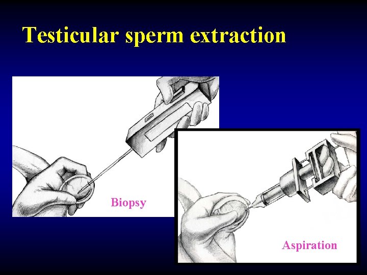 Testicular sperm extraction Biopsy Aspiration 