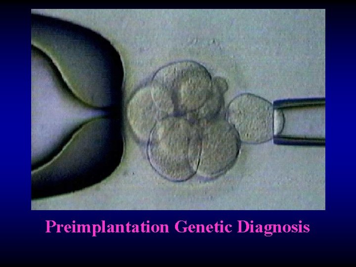 Preimplantation Genetic Diagnosis 