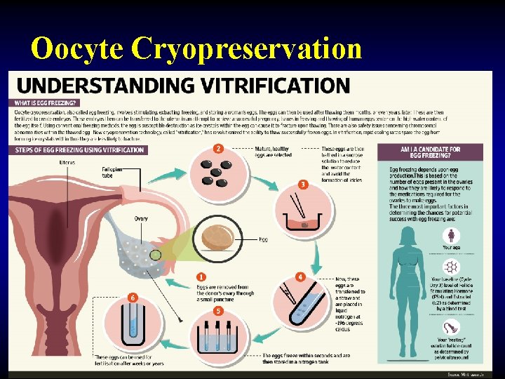 Oocyte Cryopreservation 