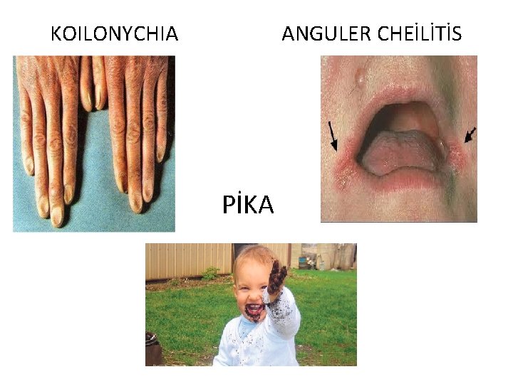 KOILONYCHIA ANGULER CHEİLİTİS PİKA 