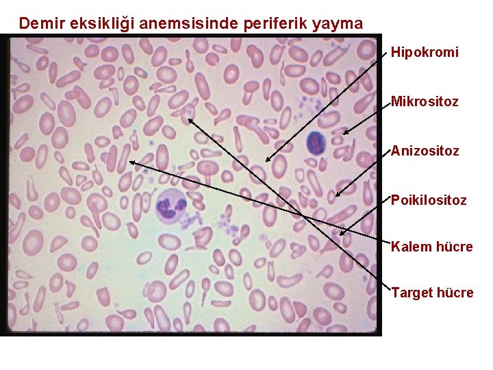 Demir eksikliği anemsisinde periferik yayma Hipokromi Mikrositoz Anizositoz Poikilositoz Kalem hücre Target hücre 