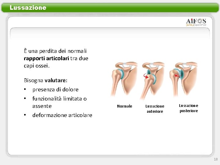 Lussazione È una perdita dei normali rapporti articolari tra due capi ossei. Bisogna valutare: