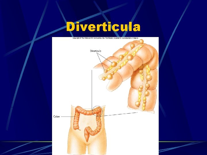 Diverticula 