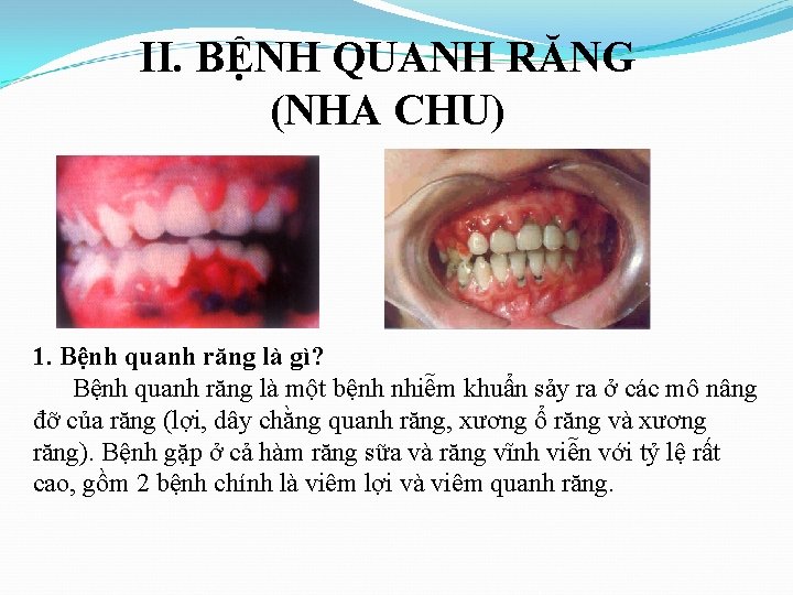 II. BỆNH QUANH RĂNG (NHA CHU) 1. Bệnh quanh răng là gì? Bệnh quanh