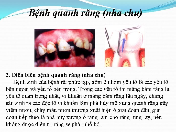 Bệnh quanh răng (nha chu) 2. Diến bệnh quanh răng (nha chu) Bệnh sinh