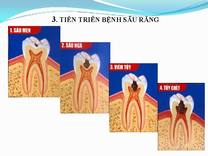 3. TIẾN TRIỂN BỆNH S U RĂNG 