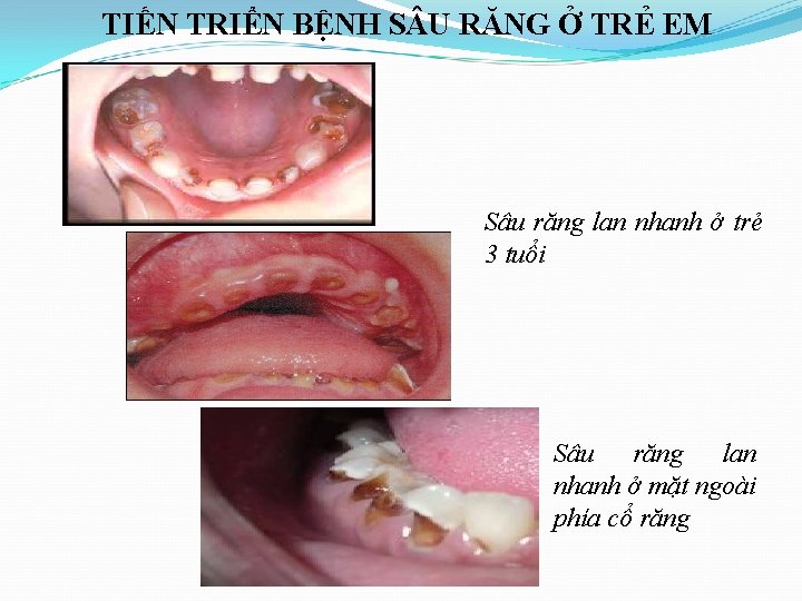 TIẾN TRIỂN BỆNH S U RĂNG Ở TRẺ EM Sâu răng lan nhanh ở