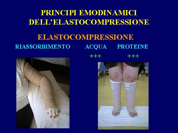 PRINCIPI EMODINAMICI DELL’ELASTOCOMPRESSIONE RIASSORBIMENTO ACQUA PROTEINE +++ 