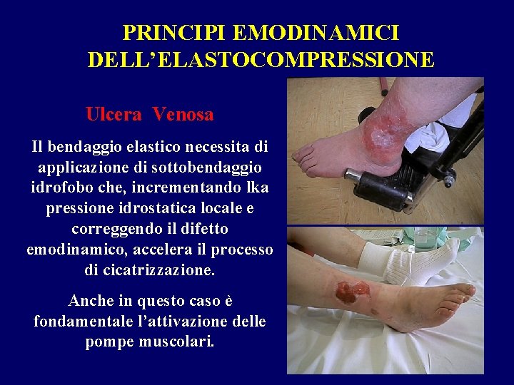 PRINCIPI EMODINAMICI DELL’ELASTOCOMPRESSIONE Ulcera Venosa Il bendaggio elastico necessita di applicazione di sottobendaggio idrofobo