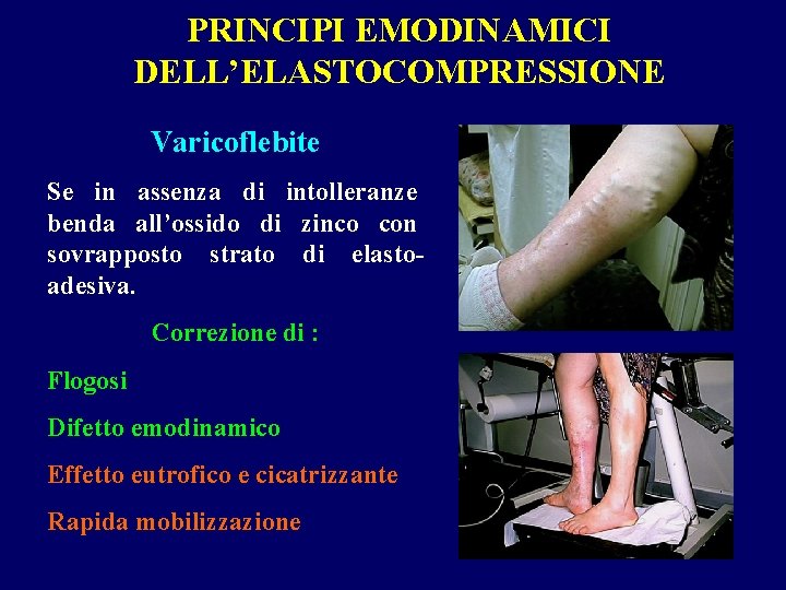 PRINCIPI EMODINAMICI DELL’ELASTOCOMPRESSIONE Varicoflebite Se in assenza di intolleranze benda all’ossido di zinco con