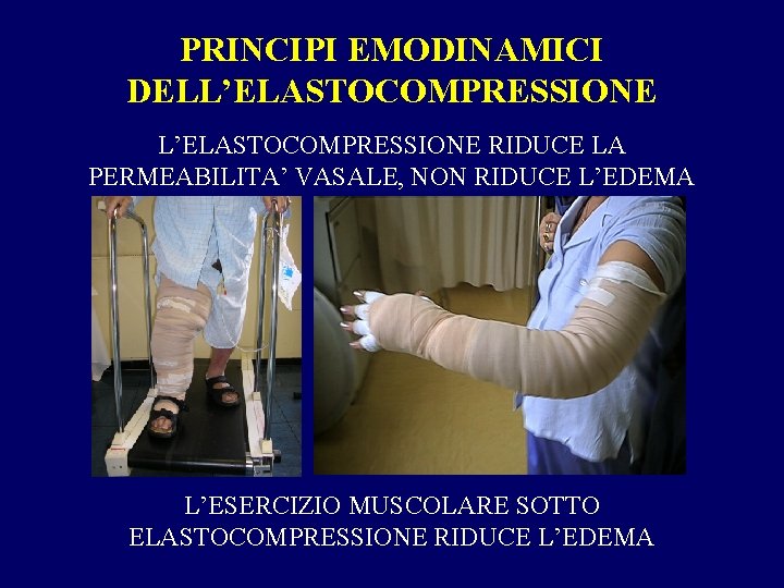 PRINCIPI EMODINAMICI DELL’ELASTOCOMPRESSIONE RIDUCE LA PERMEABILITA’ VASALE, NON RIDUCE L’EDEMA L’ESERCIZIO MUSCOLARE SOTTO ELASTOCOMPRESSIONE
