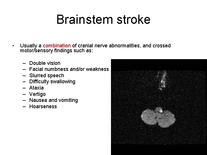 Brainstem stroke • Usually a combination of cranial nerve abnormalities, and crossed motor/sensory findings