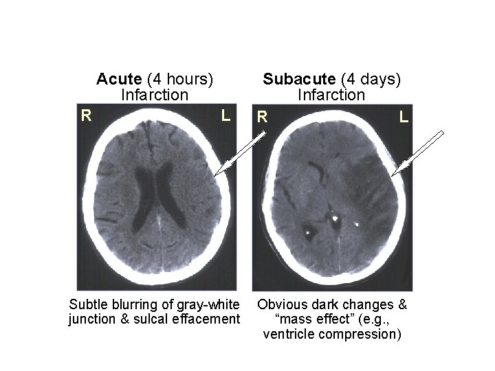 Acute (4 hours) Infarction R L Subtle blurring of gray-white junction & sulcal effacement