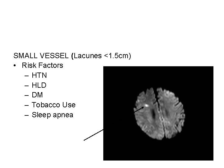 SMALL VESSEL (Lacunes <1. 5 cm) • Risk Factors – HTN – HLD –