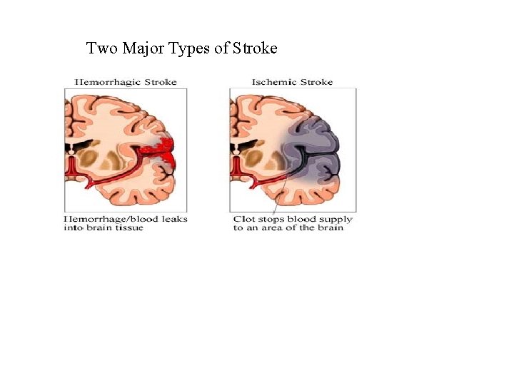 Two Major Types of Stroke 