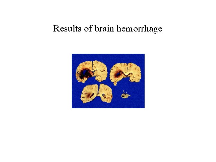 Results of brain hemorrhage 