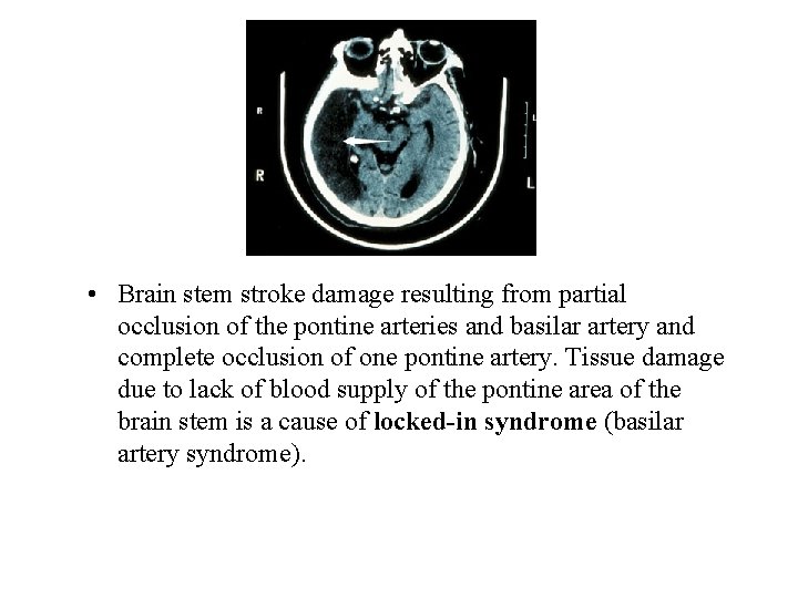  • Brain stem stroke damage resulting from partial occlusion of the pontine arteries