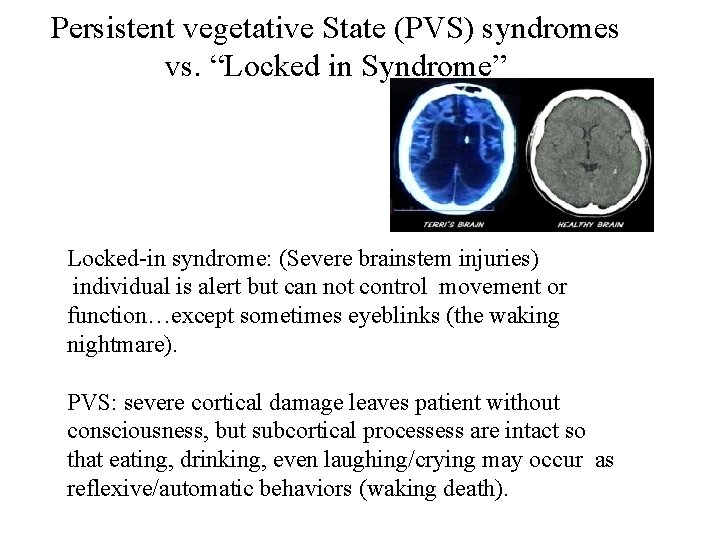 Persistent vegetative State (PVS) syndromes vs. “Locked in Syndrome” Locked-in syndrome: (Severe brainstem injuries)