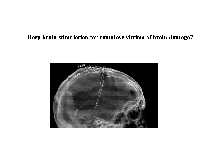 Deep brain stimulation for comatose victims of brain damage? • 